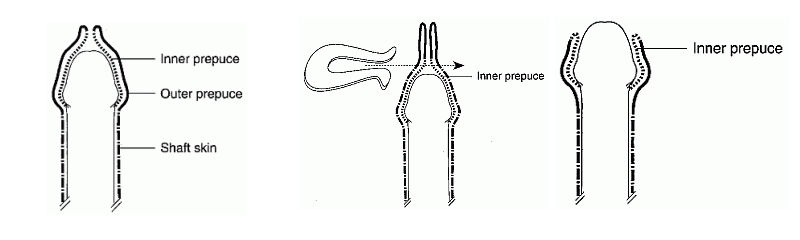 Circumcised uncircumcised